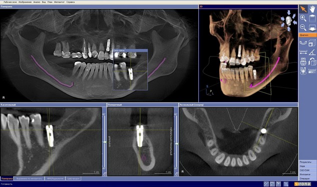 дентальный ортопантомограф Orthophos SL 3D интерфейс программы